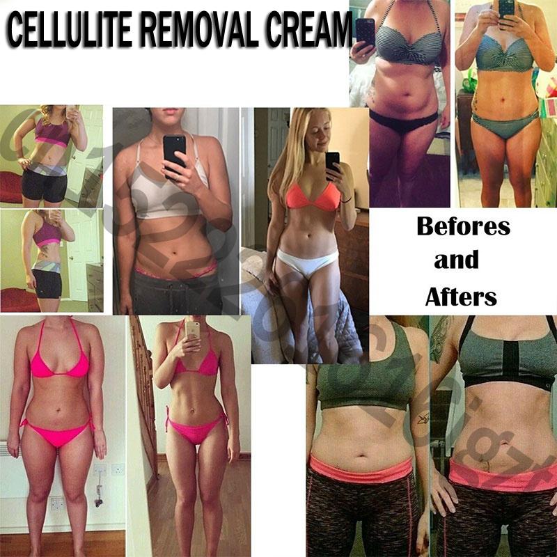 Crème dépilatoire cellulite